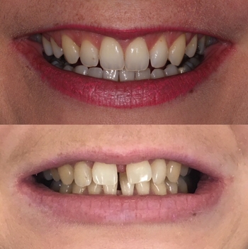 Dental treatment before and after result one
