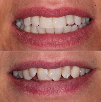 Dental treatment before and after result two