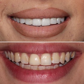 Dental treatment before and after result three